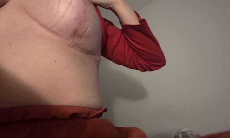 Probleme nach bruststraffung mit Implantat - 80669