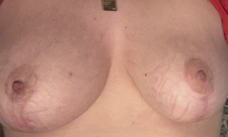 Bruststraffung mit Implantat Hilfe - 80686
