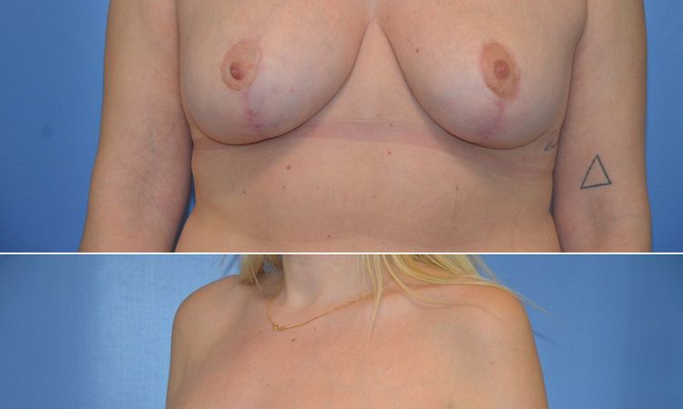 Bruststraffung mit Implantat Hilfe - 80687