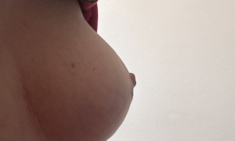 Bruststraffung mit Implantat Hilfe - 80689