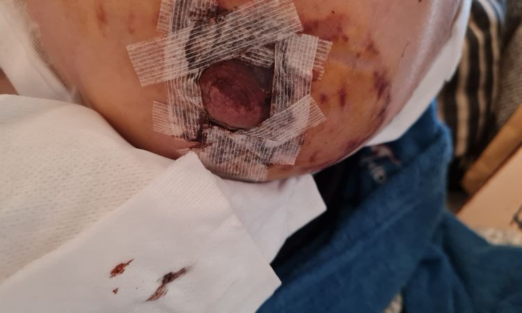 Brustverkleinerung, Brustwarze teilweise dunkel - 80737