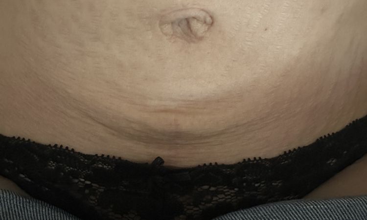 Bauchdeckenstraffung mit kleinen T- Schnitt Bitte um Ihre Meinung - 80757