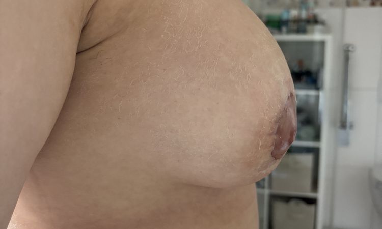 Beide Implantate sitzen falsch?! BV mit Straffung - 80766