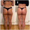 Extreme Bananenfalte am Oberschenkel nach Liposuktion