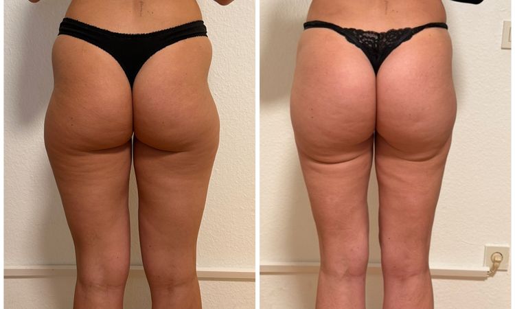 Extreme Bananenfalte am Oberschenkel nach Liposuktion - 80859