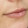 Lippen aufspritzen, Schwellung oder zu viel