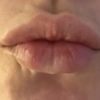 Lippen aufspritzen, Schwellung oder zu viel