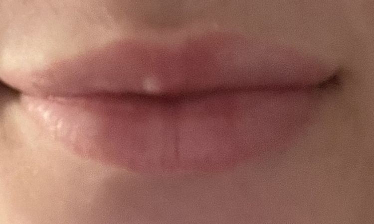 Lippen aufspritzen, Schwellung oder zu viel - 80910
