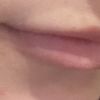 Lippen aufspritzen, Schwellung oder zu viel