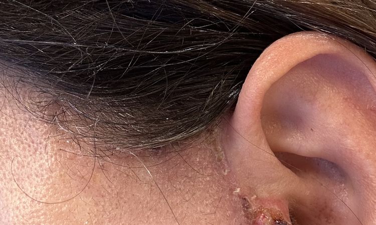 Kruste rechter Tragus, Haut gerötet – was tun nach Face-OP? - 80941