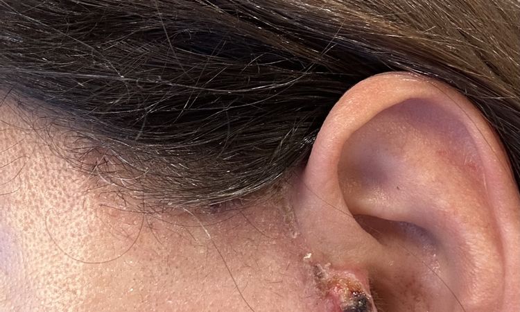 Kruste rechter Tragus, Haut gerötet – was tun nach Face-OP? - 80942