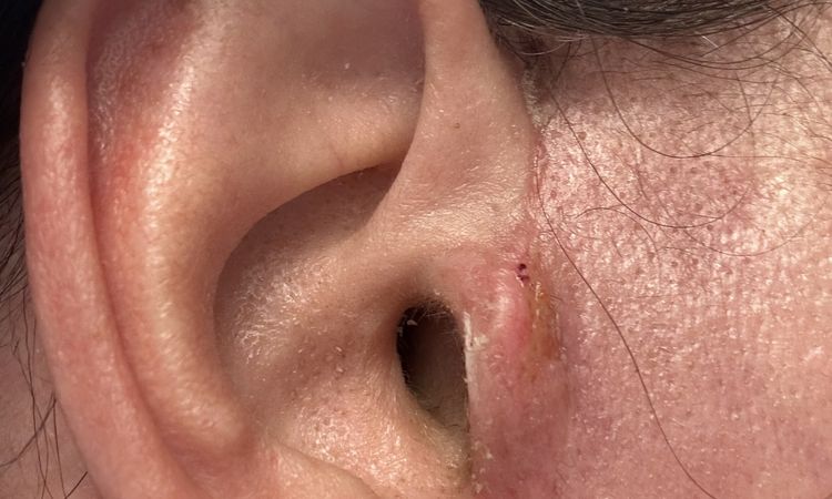 Kruste rechter Tragus, Haut gerötet – was tun nach Face-OP? - 80943