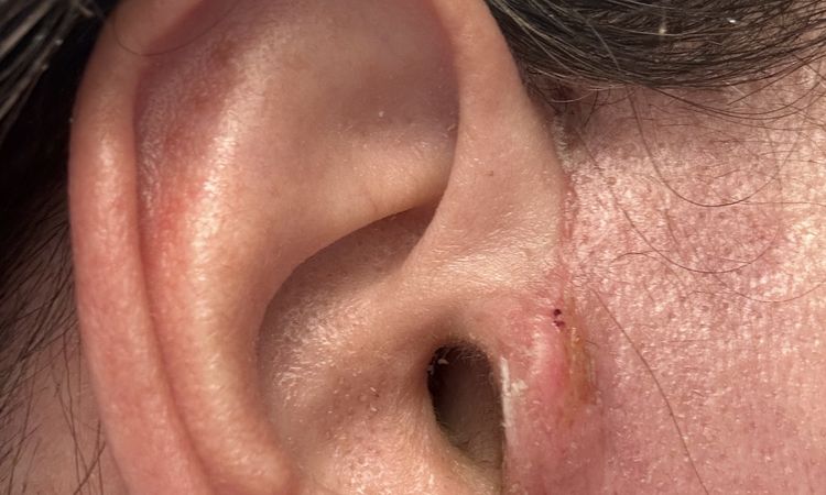 Kruste rechter Tragus, Haut gerötet – was tun nach Face-OP? - 80944