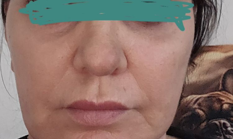 Facelift nicht gut gelungen - 80949