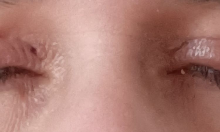 Oberlidstraffung Augen schließen nicht - 80998
