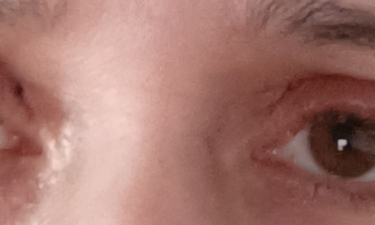 Oberlidstraffung Augen schließen nicht - 80999