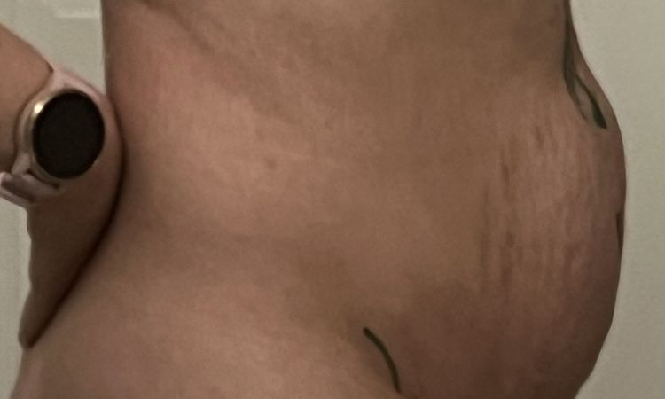Probleme nach Bauchdeckenstraffung - Naht hat nicht gehalten - 81054