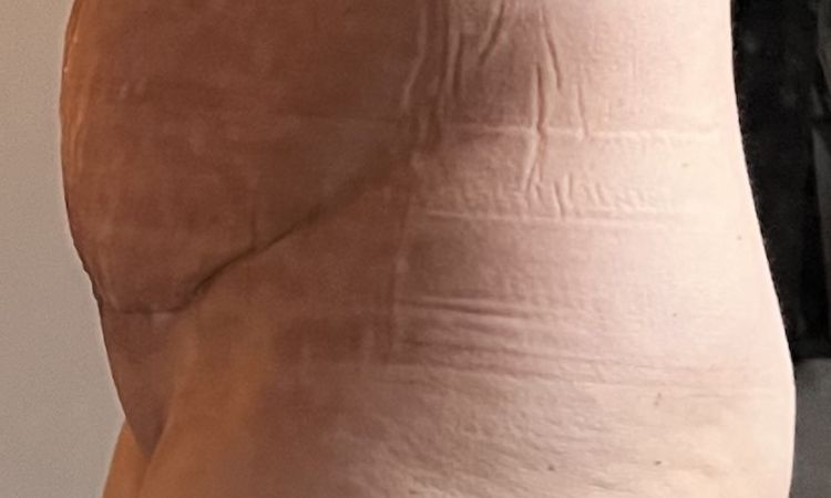 Probleme nach Bauchdeckenstraffung - Naht hat nicht gehalten - 81055