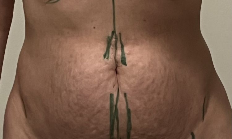 Probleme nach Bauchdeckenstraffung - Naht hat nicht gehalten - 81056