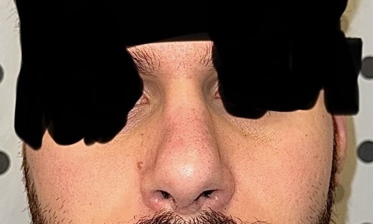 Delle am Knochen-Knorpel-Übergang 3½ Monate post-OP - 81180