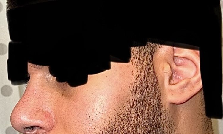 Delle am Knochen-Knorpel-Übergang 3½ Monate post-OP - 81181
