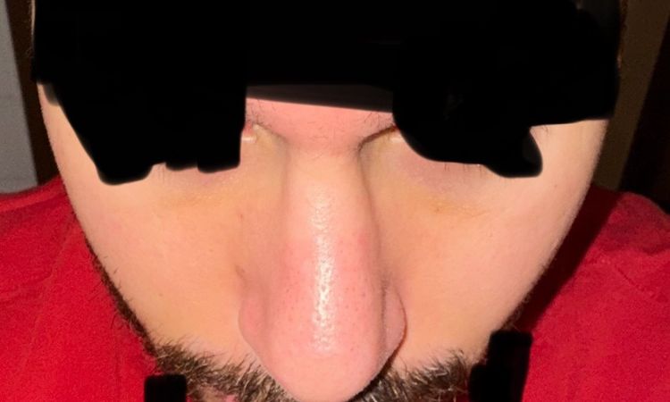 Delle am Knochen-Knorpel-Übergang 3½ Monate post-OP - 81183
