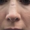 Nase 2x operiert/ Narbengewebe?