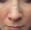 Nase 2x operiert/ Narbengewebe?