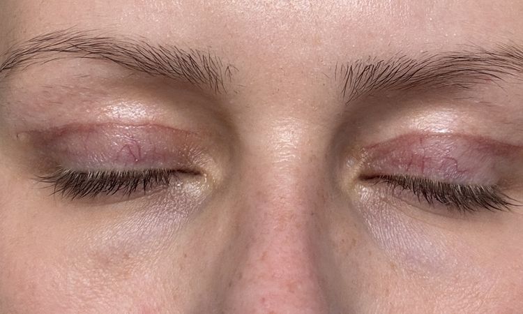 Lidschluss nach Oberlidstraffung nicht ganz möglich - 81254