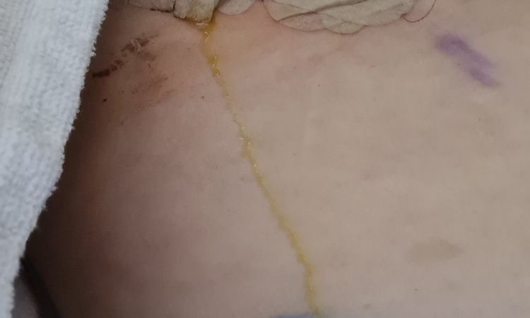 Gelbe Brüste nach OP - 81272