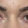 Asymmetrie nach Oberlidstraffung