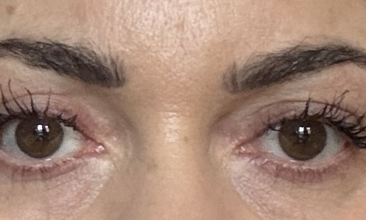 Asymmetrie nach Oberlidstraffung - 81293