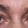 Asymmetrie nach Oberlidstraffung