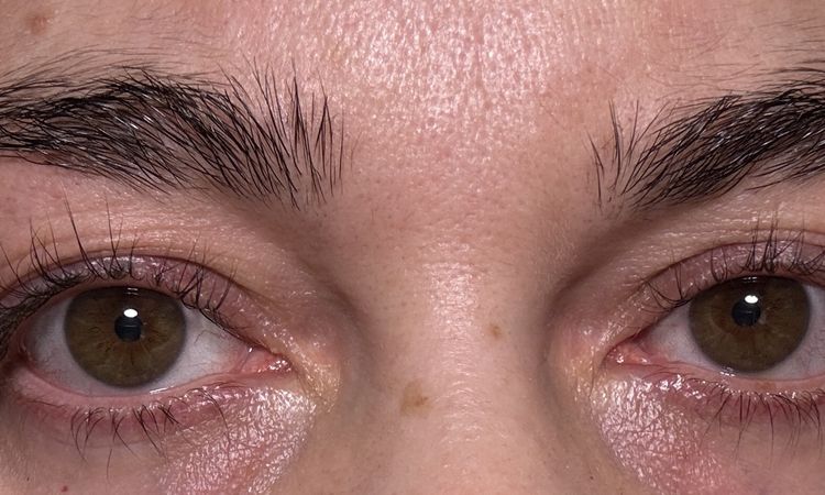 Asymmetrie nach Oberlidstraffung - 81294