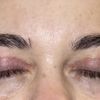 Asymmetrie nach Oberlidstraffung