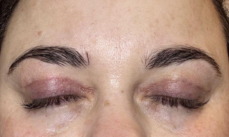 Asymmetrie nach Oberlidstraffung - 81295