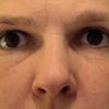 Asymmetrie nach Oberlidstraffung
