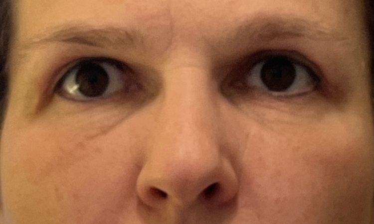 Asymmetrie nach Oberlidstraffung - 81309