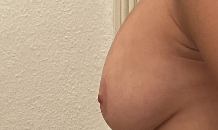 Unerkannte Waterfall Deformity 1,5 Jahre Post OP? - 81345