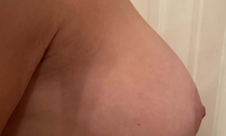 Unerkannte Waterfall Deformity 1,5 Jahre Post OP? - 81346