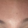Botox - Augenbrauen unterschiedlich hoch