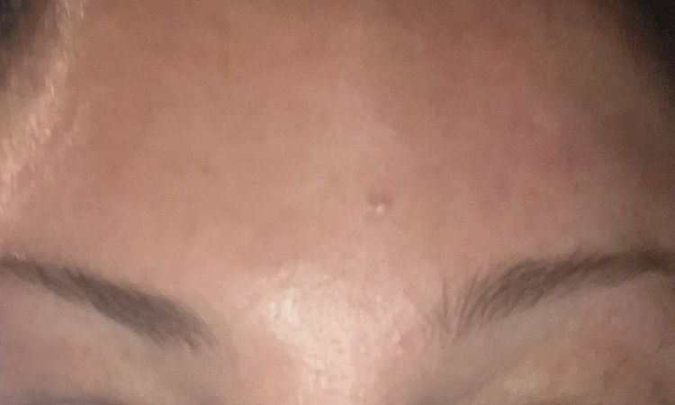 Botox - Augenbrauen unterschiedlich hoch - 81360