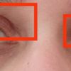 Oberliedstraffung asymmetrische Augen