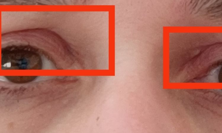 Oberliedstraffung asymmetrische Augen - 81374