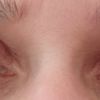 Oberliedstraffung asymmetrische Augen