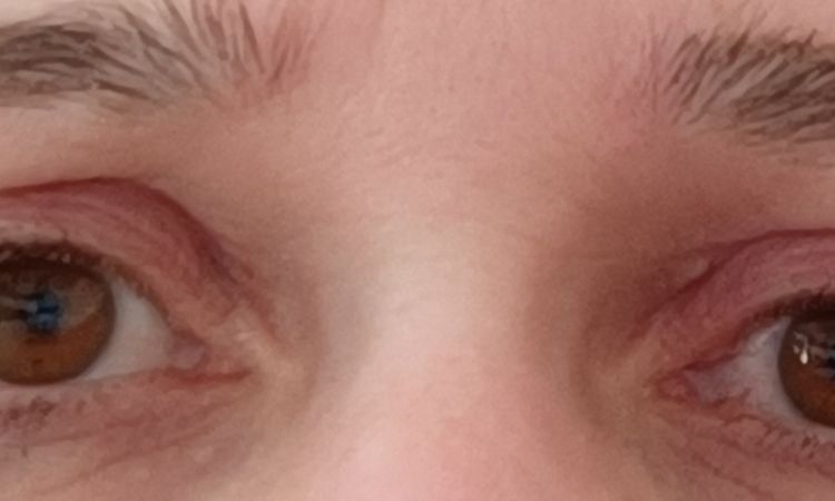 Oberliedstraffung asymmetrische Augen - 81375