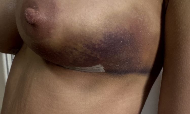 Ist diese Verformung der Brust 10 Tage nach Brustvergrösserung  normal ? - 81382