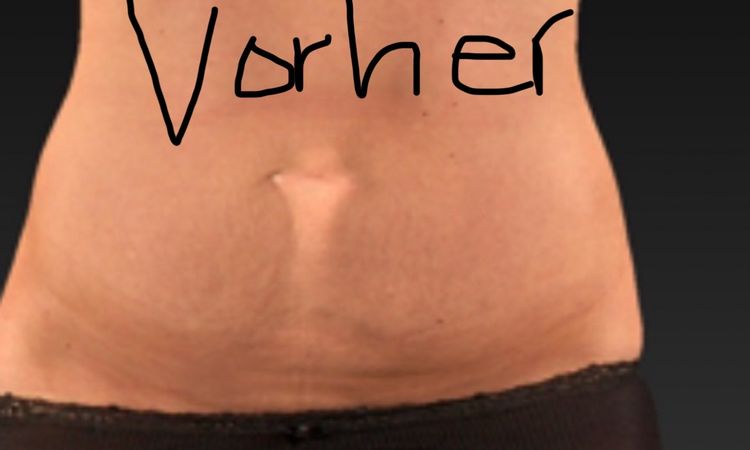 Revision nach Bauchdeckenstraffung - 81396
