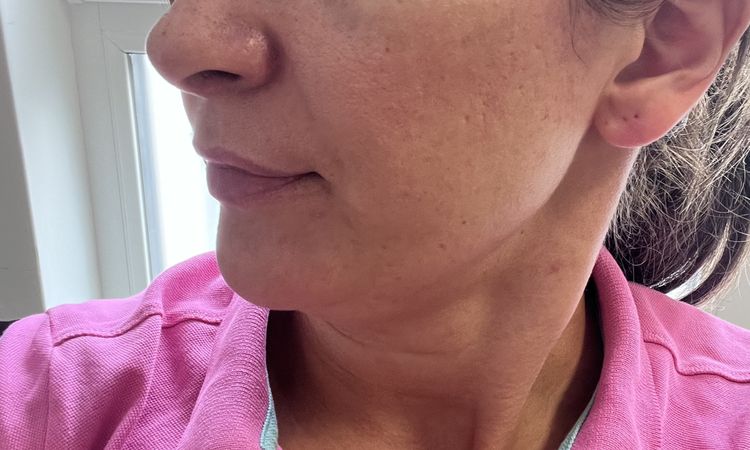Alar retraction, rechts - 81436