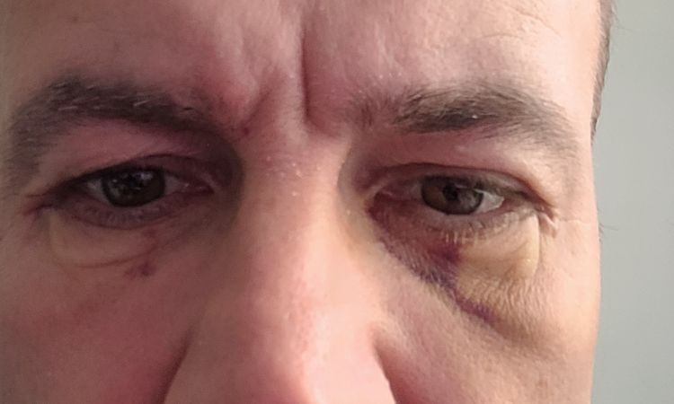 Nach Unterlidstraffung Tränensack nicht vollständig weg - 81447